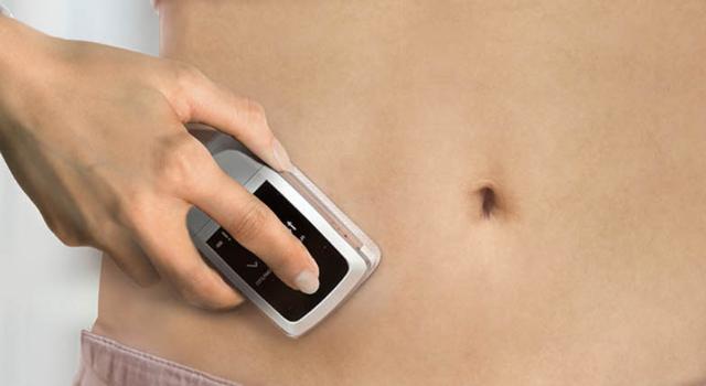 Swiss Startup - Sensile Medical AG (acquired by Gerresheimer) Main Image