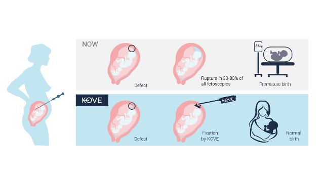 Swiss Startup - KOVE medical Additional Image
