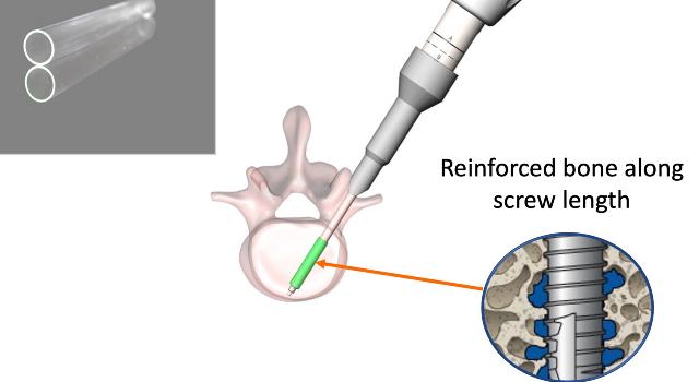 Swiss Startup - NX-Spine Product Image